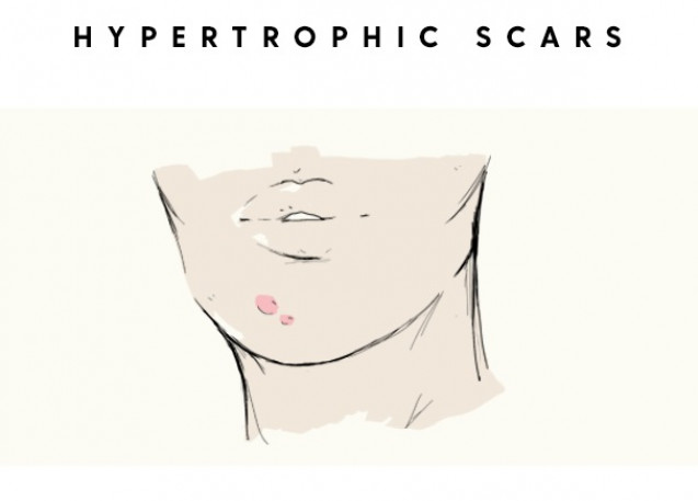 Cara merawat kulit wajah hyperthropic scar